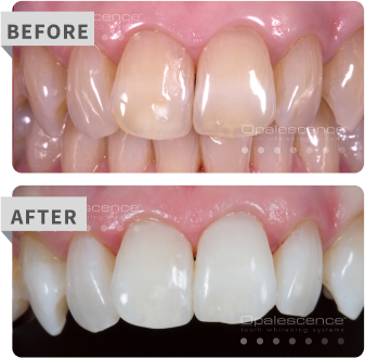 pf before after