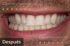 After using Opalescence Endo