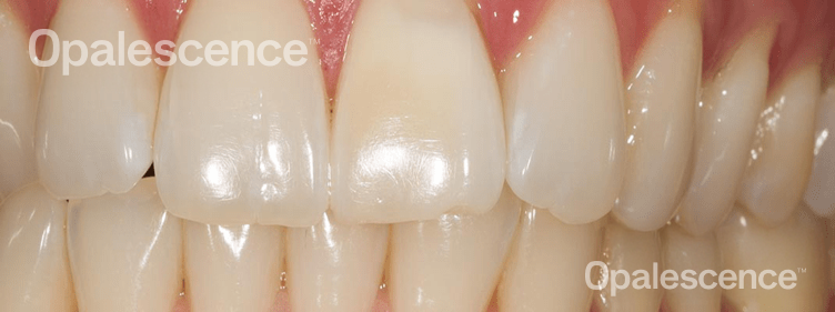 After Opalescence tooth whitening system