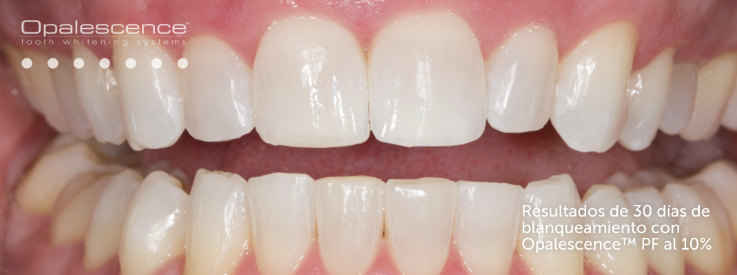 Después del sistema de blanqueamiento dental Opalescence