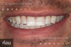 Before using Opalescence Endo