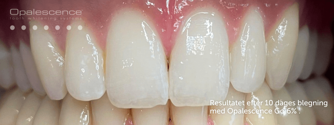 Efter tandblegning med Opalescence-systemet
