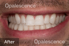 After using Opalescence Endo