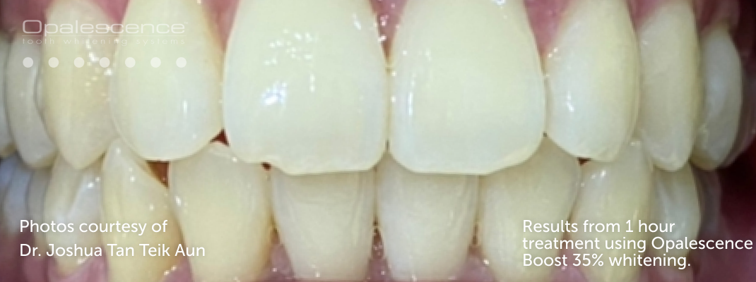 Before Opalescence tooth whitening system