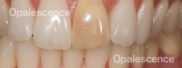 Before Opalescence tooth whitening system