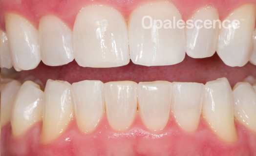 After Opalescence tooth whitening system