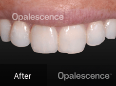 After using Opalescence Endo