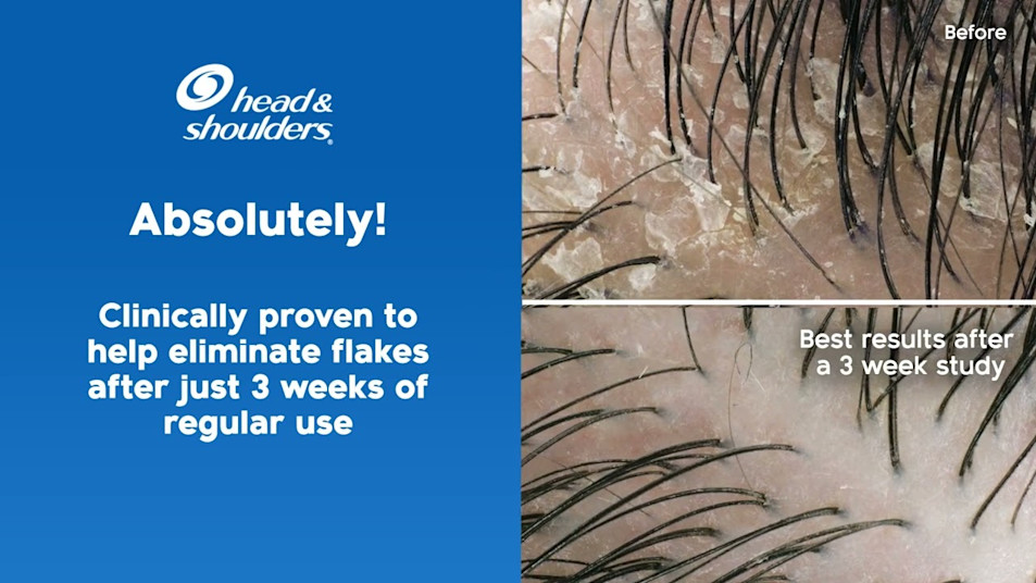 The science of dandruff The science of dandruff
