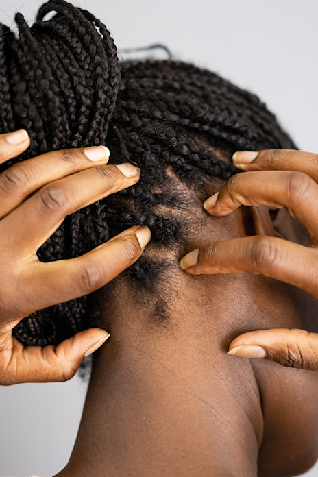5 Essential Itchy Scalp Remedies for Protective Styles-image 5 Essential Itchy Scalp Remedies for Protective Styles-image