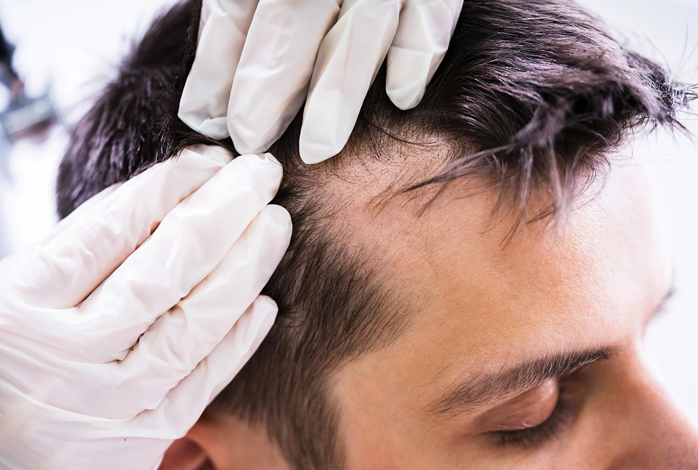 Gloved hands on a tan-skinned man's head to check if there is dandruff in front of a white background. Gloved hands on a tan-skinned man's head to check if there is dandruff in front of a white background.