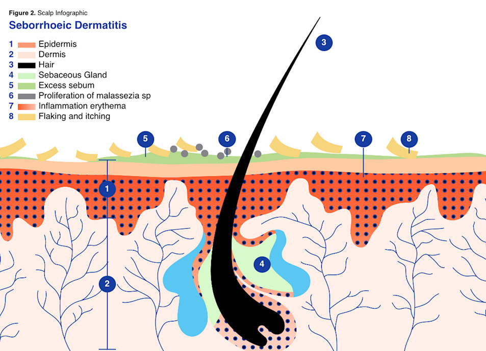 DANDRUFF TRIGGERS DANDRUFF TRIGGERS
