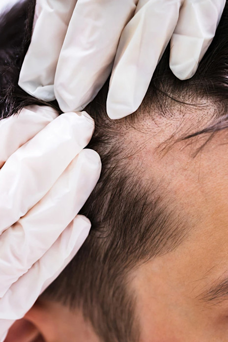 The Science of Dandruff-image The Science of Dandruff-image
