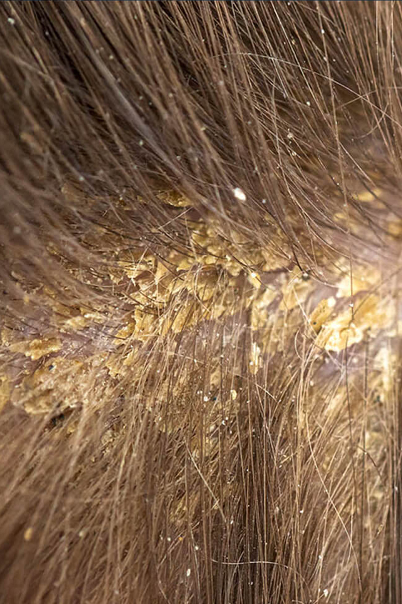What kind of dandruff is this large flake with holes? : r/dandruff