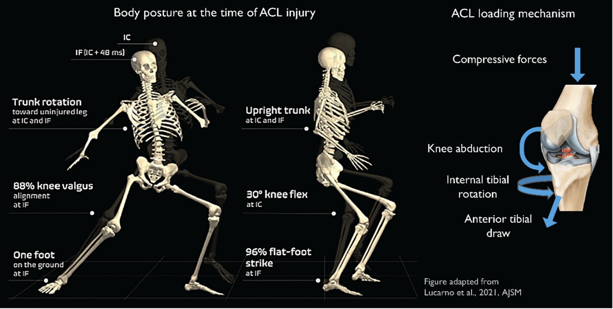 テクノロジーを使用し女性アスリートにおけるACL損傷のリスク要因を