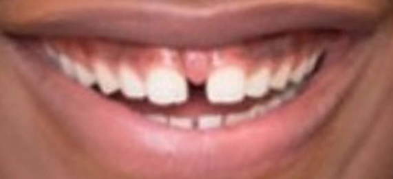 SmileDirectClub Club member before photo with Teeth Spacing Condition