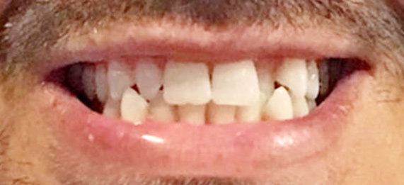 Teeth Conditions-Crossbite