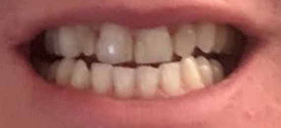 Teeth Conditions-Underbite