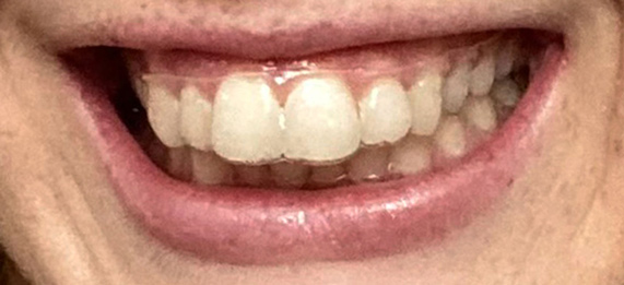 SmileDirectClub Club member before photo with Overbite Teeth Condition