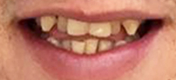 SmileDirectClub Club member before photo with Crowding Teeth Condition