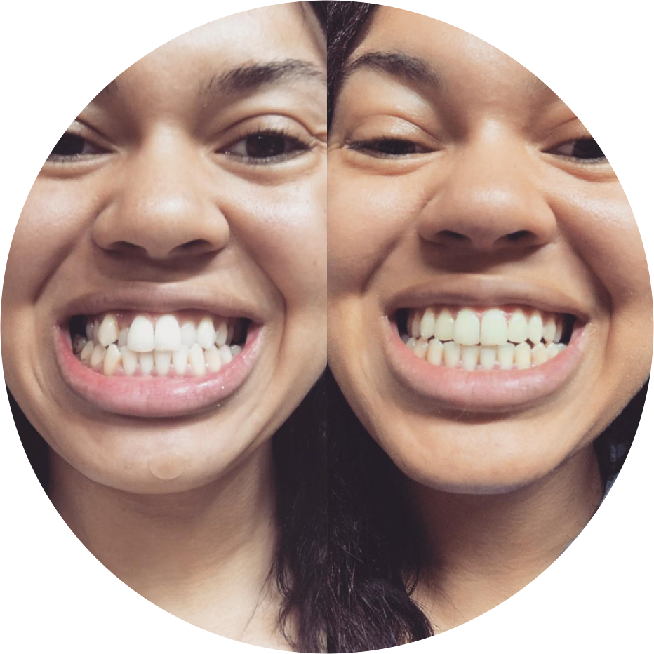 Clear Aligners & Teeth Straightening Kits | SmileDirectClub