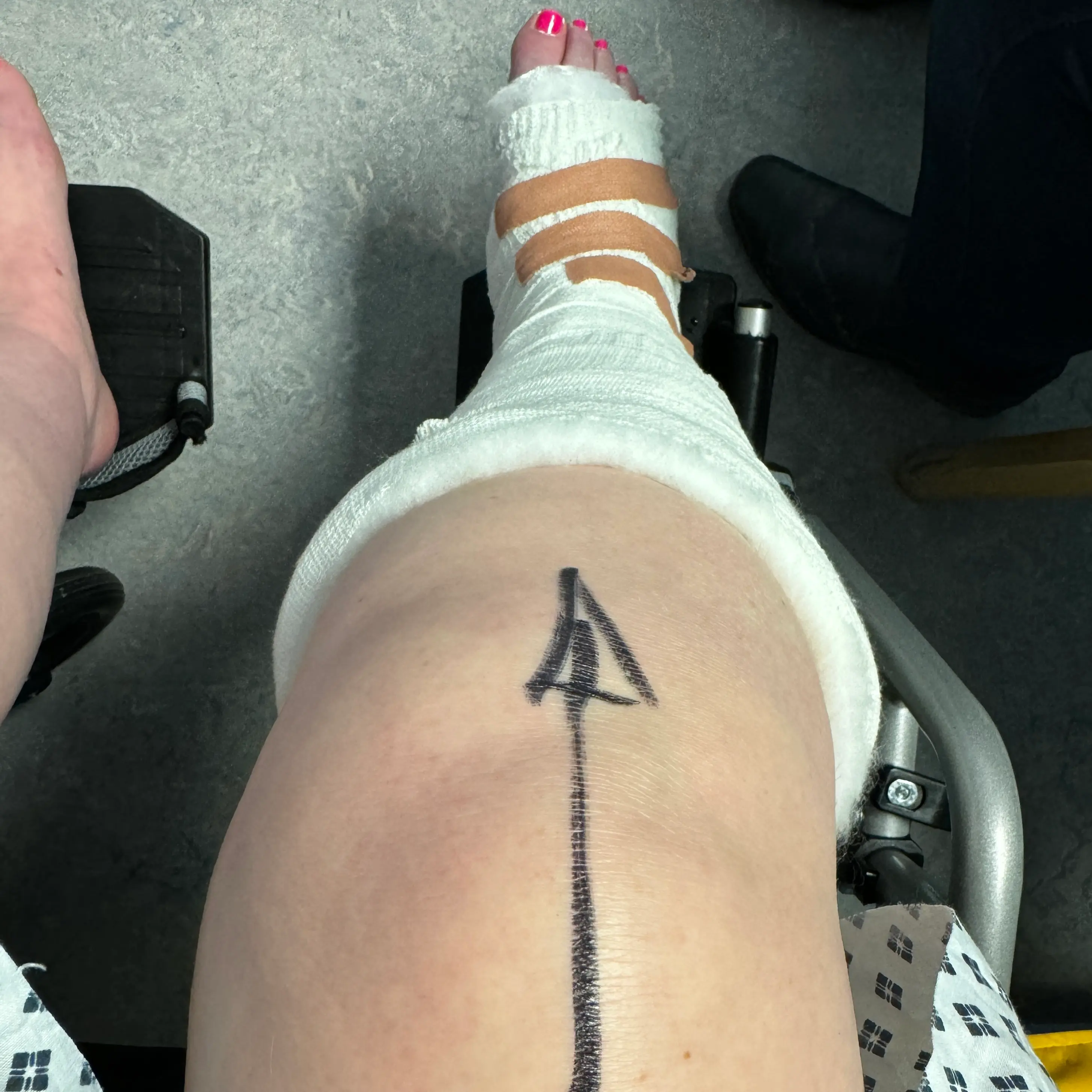 Breaking my leg wasn’t on my 2024 vision board