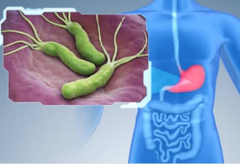 H. Pylori