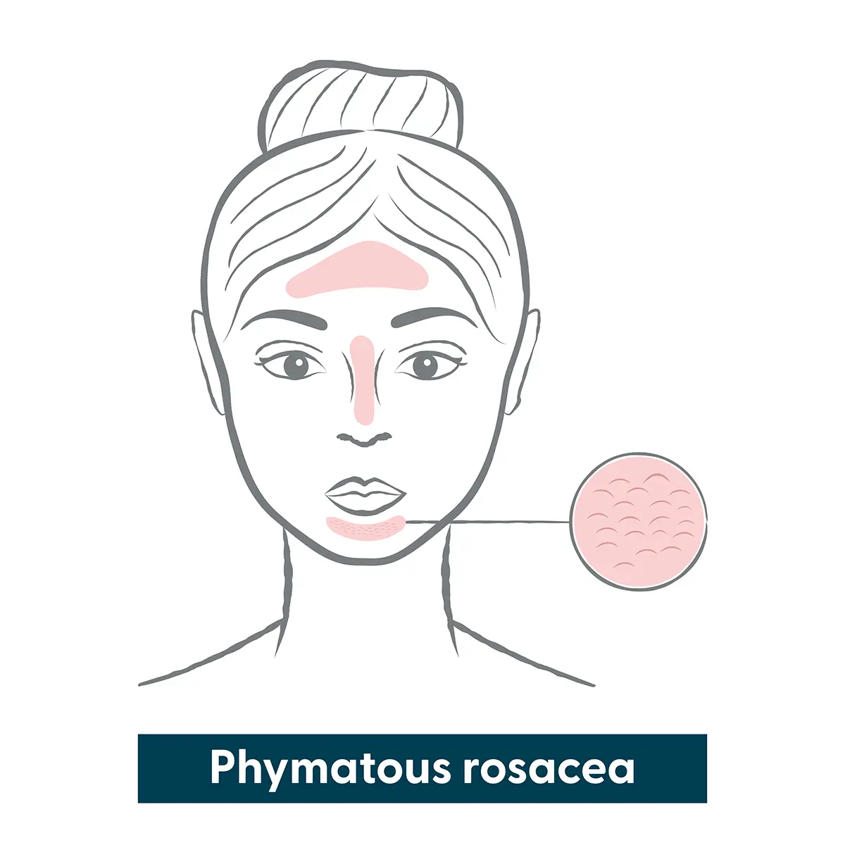 Infographic of phymatous rosacea