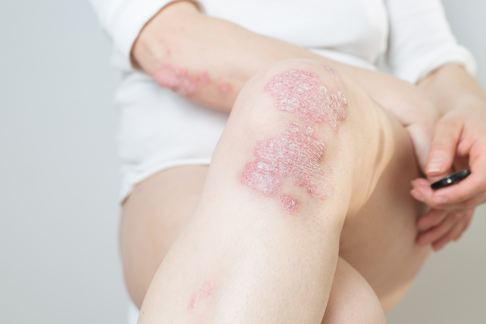 A woman with her legs crossed, with psoriasis on her arms and legs. 