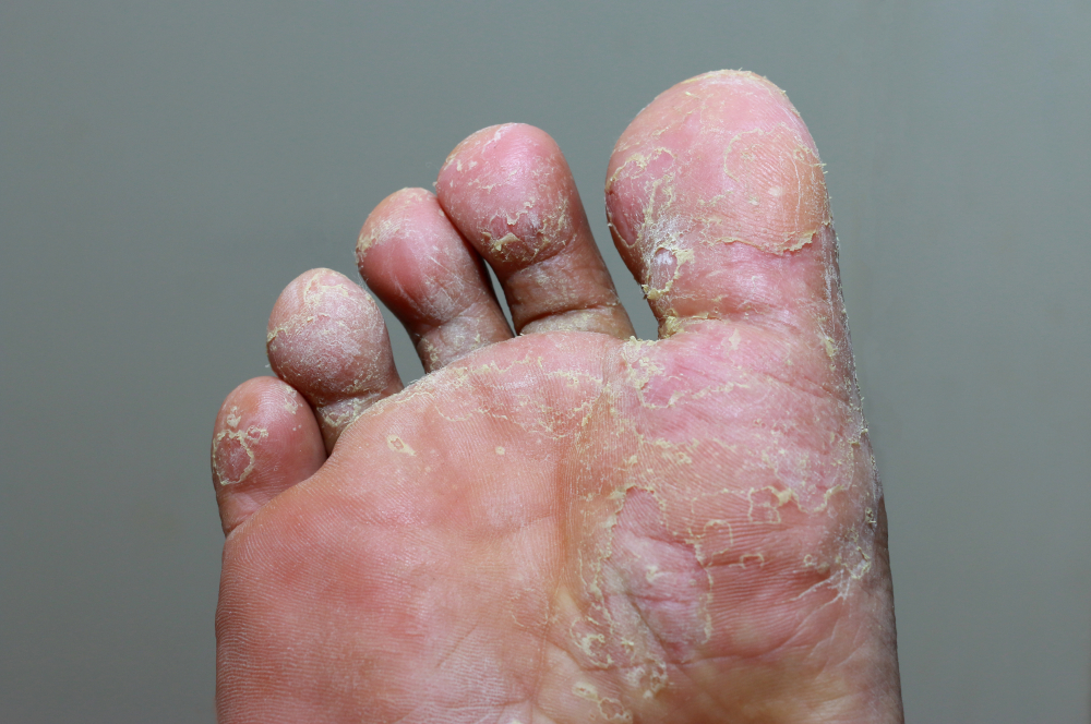 A closeup of athlete's foot. Symptoms include a scaly rash that usually causes itching, stinging, and burning. People with athlete's foot can have moist, raw skin between their toes.