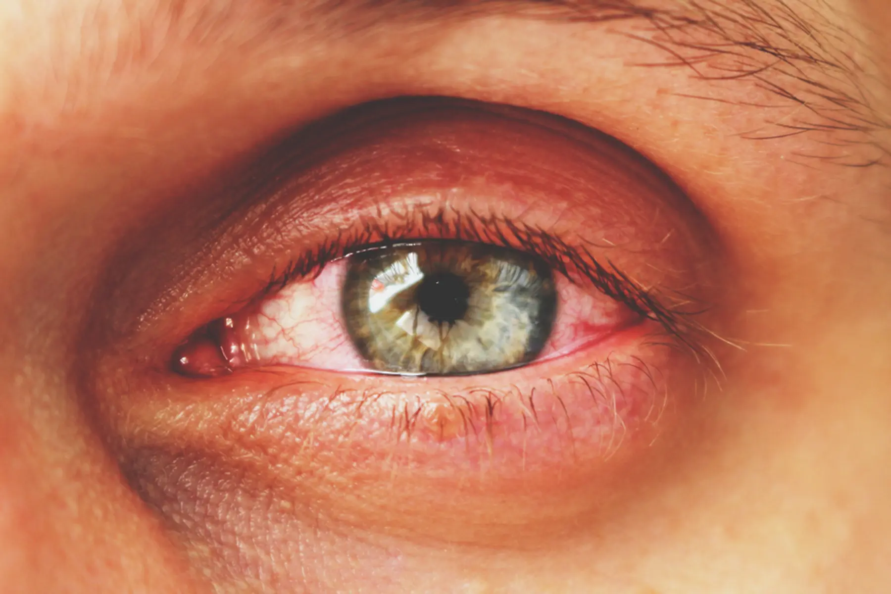 Close-up of a person's eye. The eye looks very inflamed and irritated. It is red and puffy. 