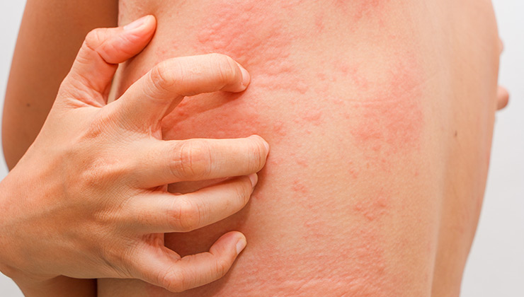 What Is An Amoxicillin Allergy Rash Back 