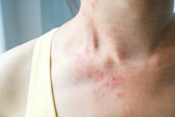 A rash on the neck and chest.