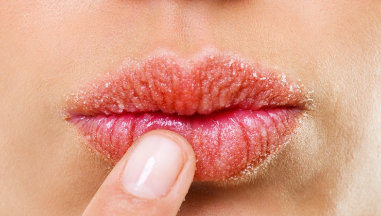 Allergic Reactions On The Lips: Causes And Treatments | Lifemd