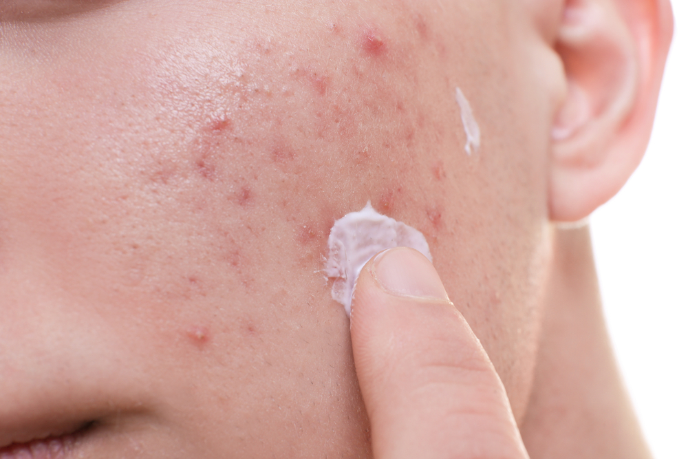 Close-up of a boy putting cream on his acne.