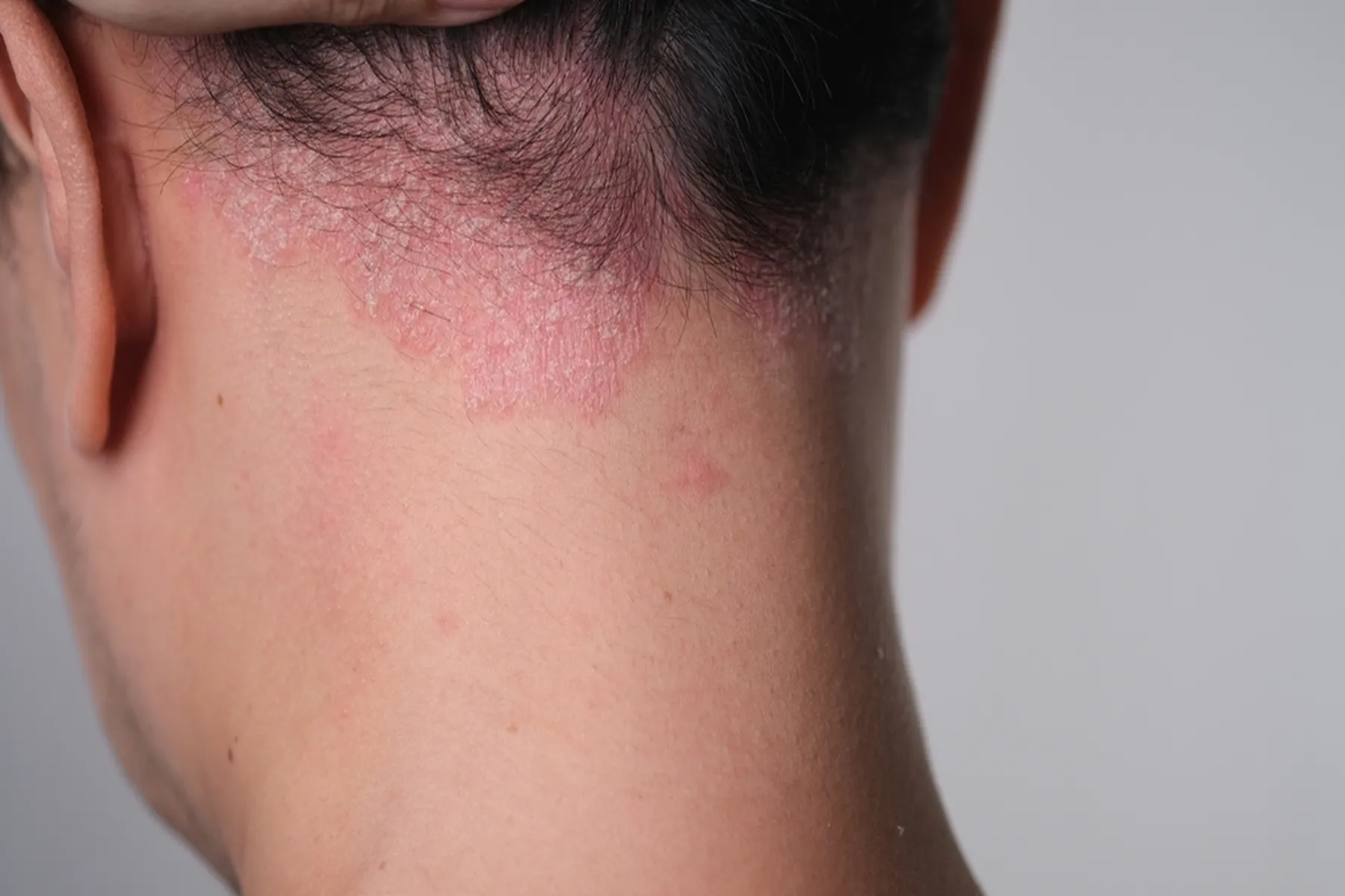 Psoriasis on the back of a person's neck.