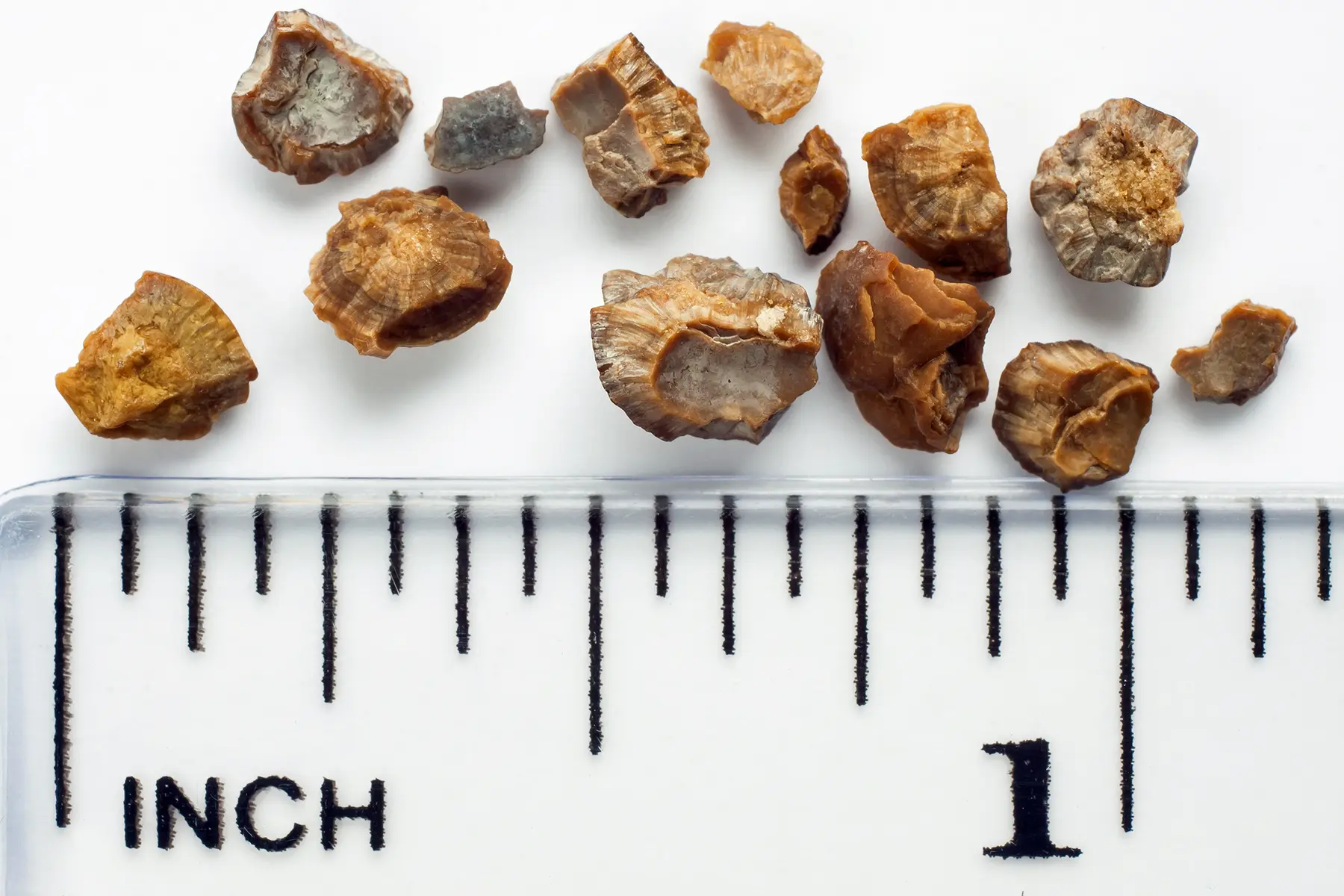 Causes and Symptoms of Kidney Stones LifeMD