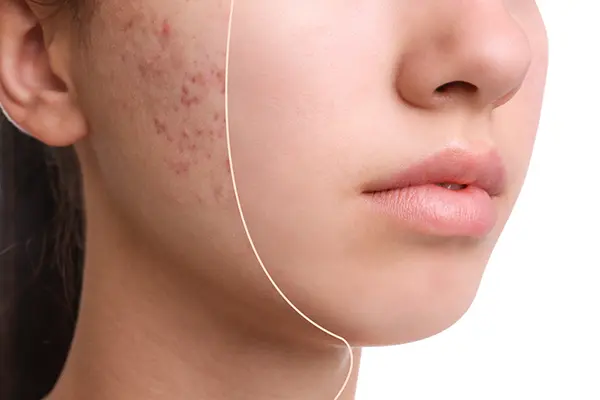 Close-up of a girl's cheek where acne scars are disappearing.