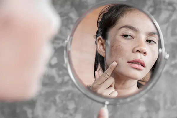 A woman with some pigmentation on her cheeks looks into a mirror. The woman's reflection is the main image in the photo. 