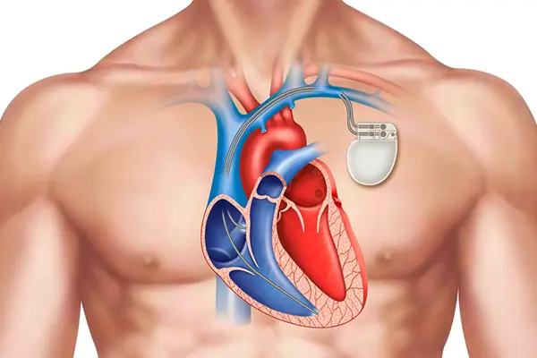 Diagram of the heart with a pacemaker.