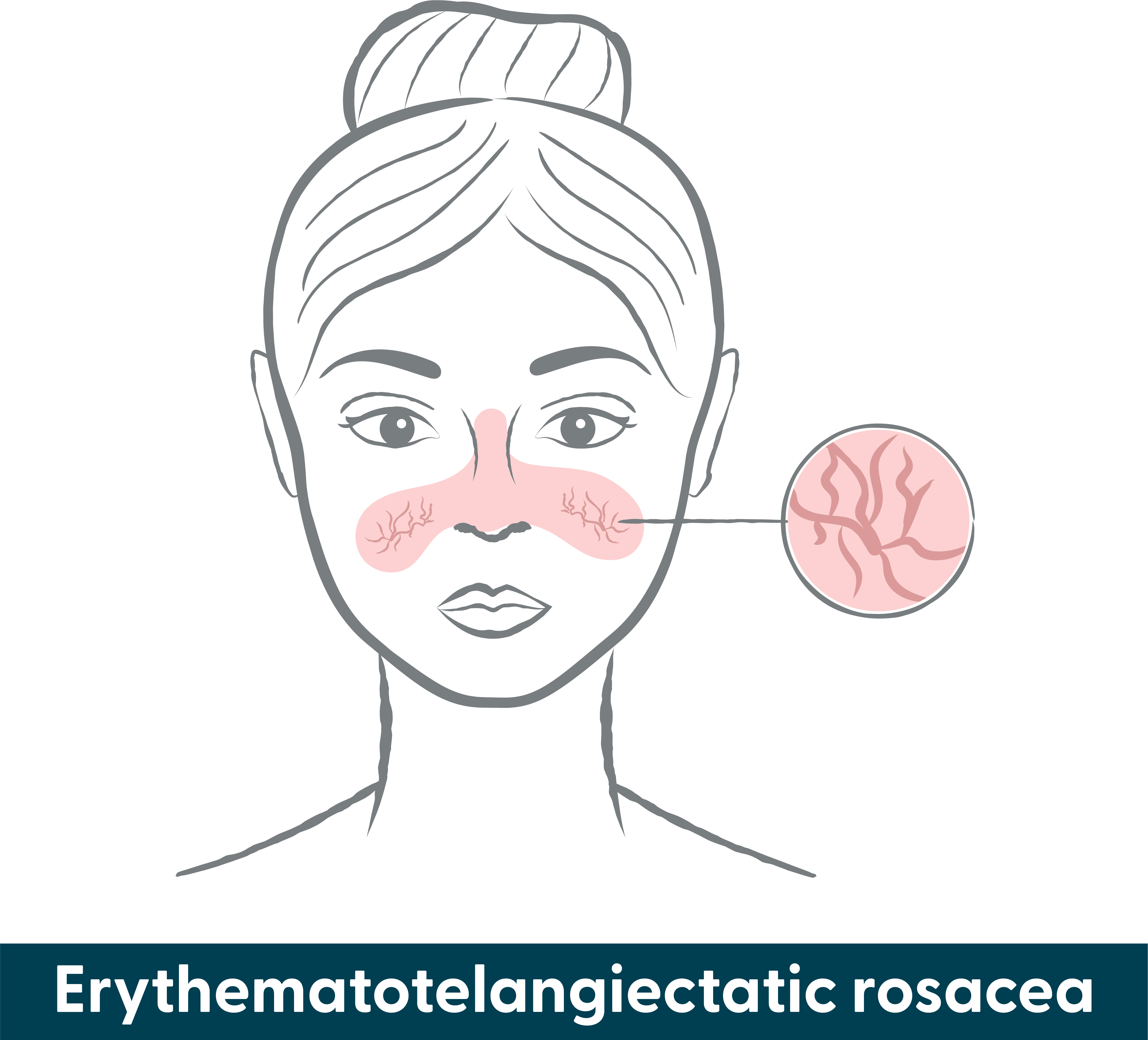 infographic of erythematotelangiectatic rosacea