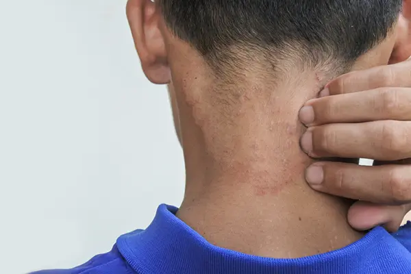 A man reaches behind his neck and scratches at a scabies rash.
