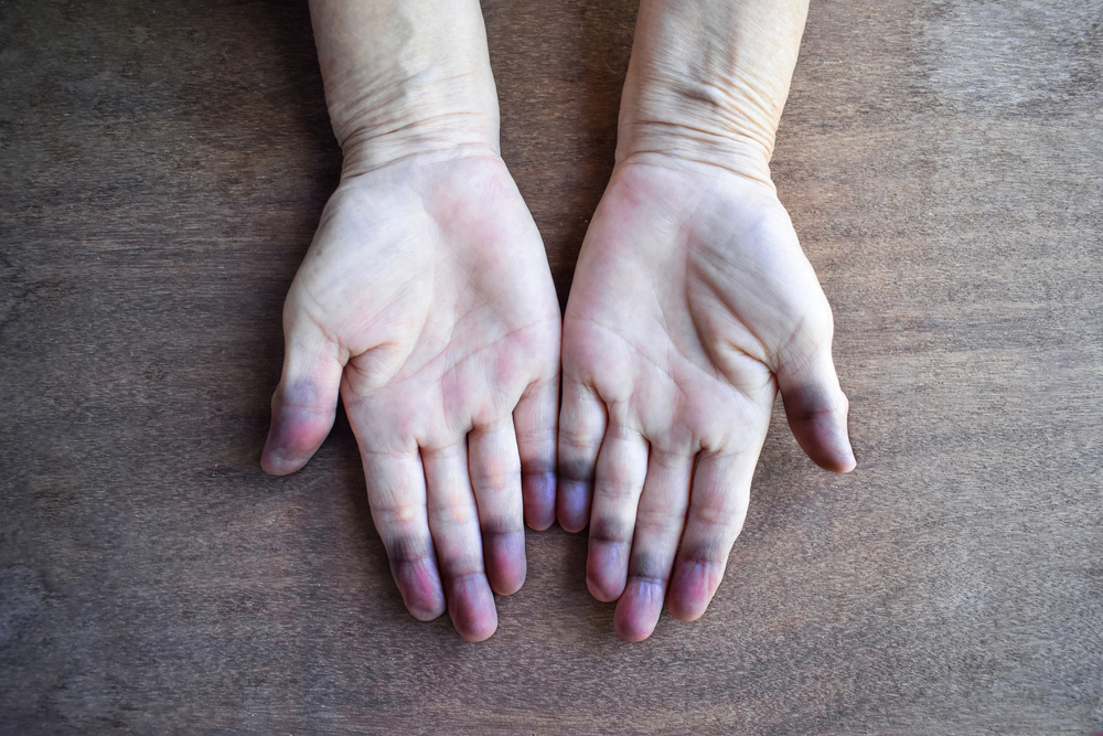 A bluish tint on the ends of fingertips due to cyanosis.