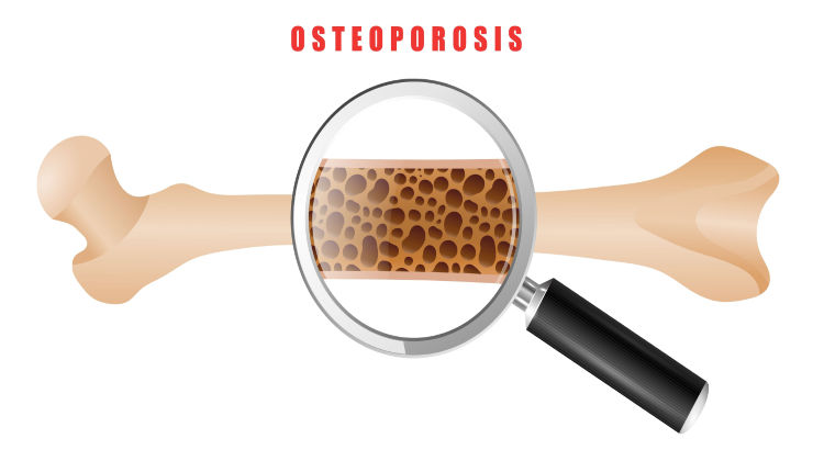 A drawing of a human bone with a magnifying glass focusing in on the middle of the bone. There are many holes in the bone, representing osteoporosis. The word 