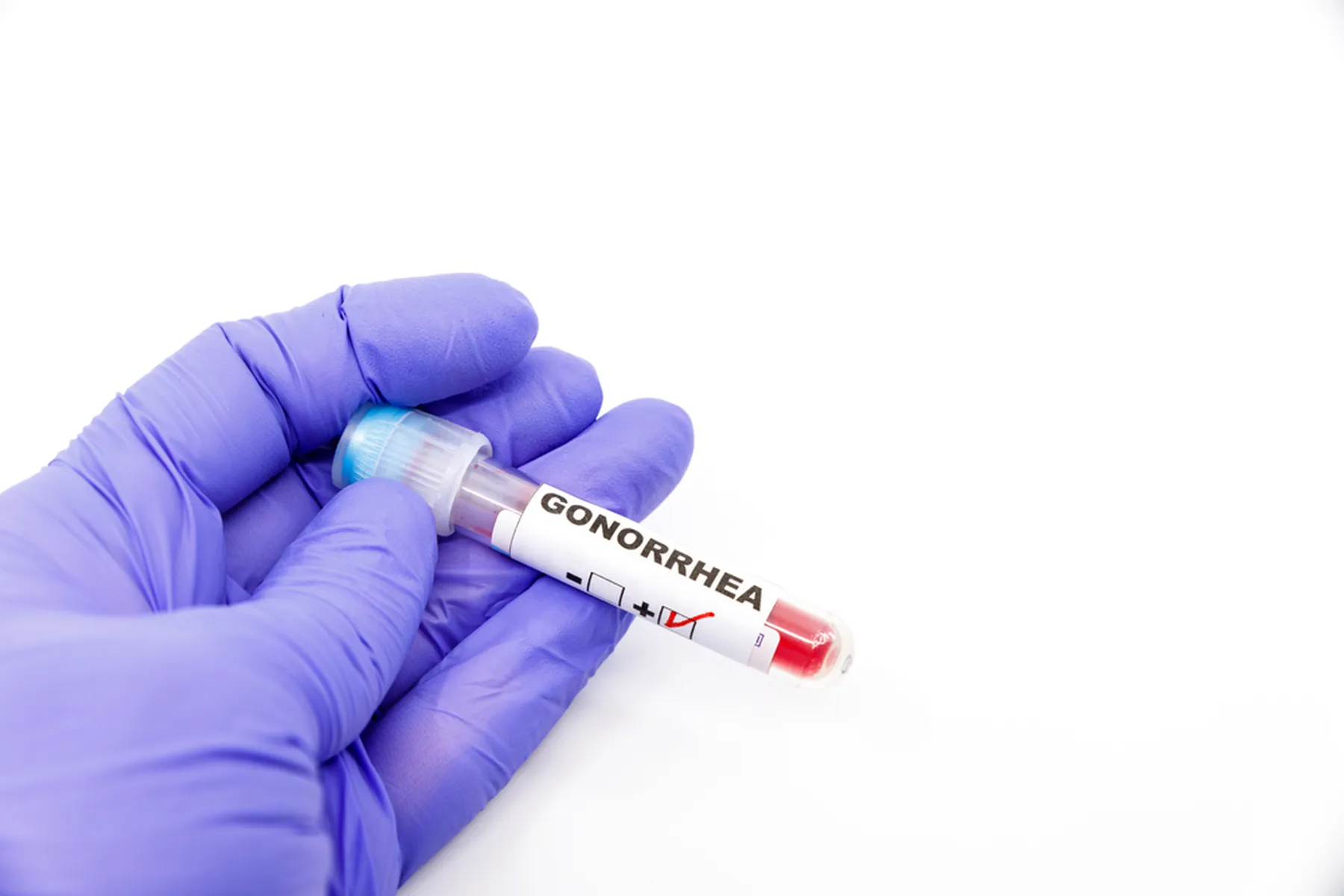 A positive gonorrhea test is held by a gloved hand.