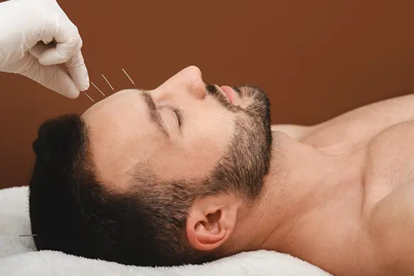 Man lying down and receiving acupuncture. There are four acupuncture needles placed near his forehead. 