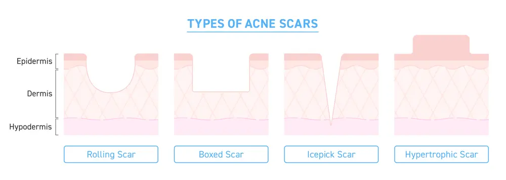 Infographic of the 4 different types of acne scars and their roles in the epidermis, dermis, and hypodermis.