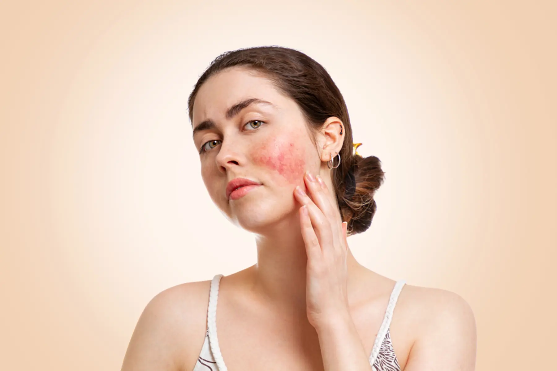 Woman touching the rosacea on her face.