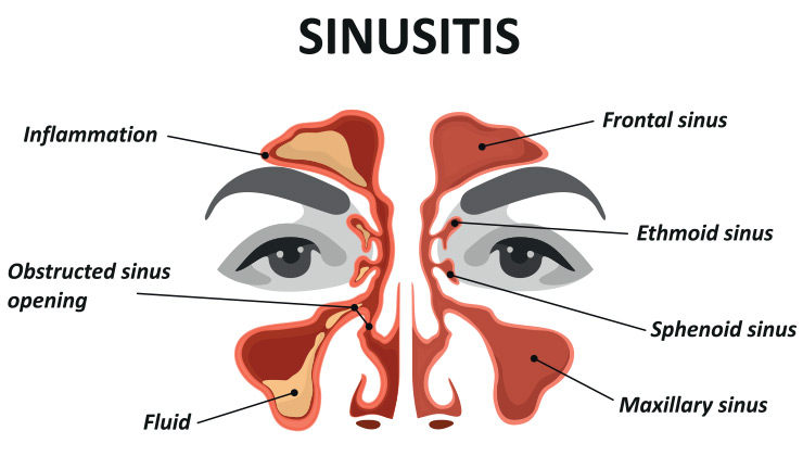 Can You Have Both Covid And Sinus Infection