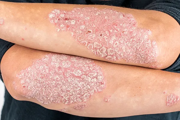 A psoriasis flare-up on someone's elbow.