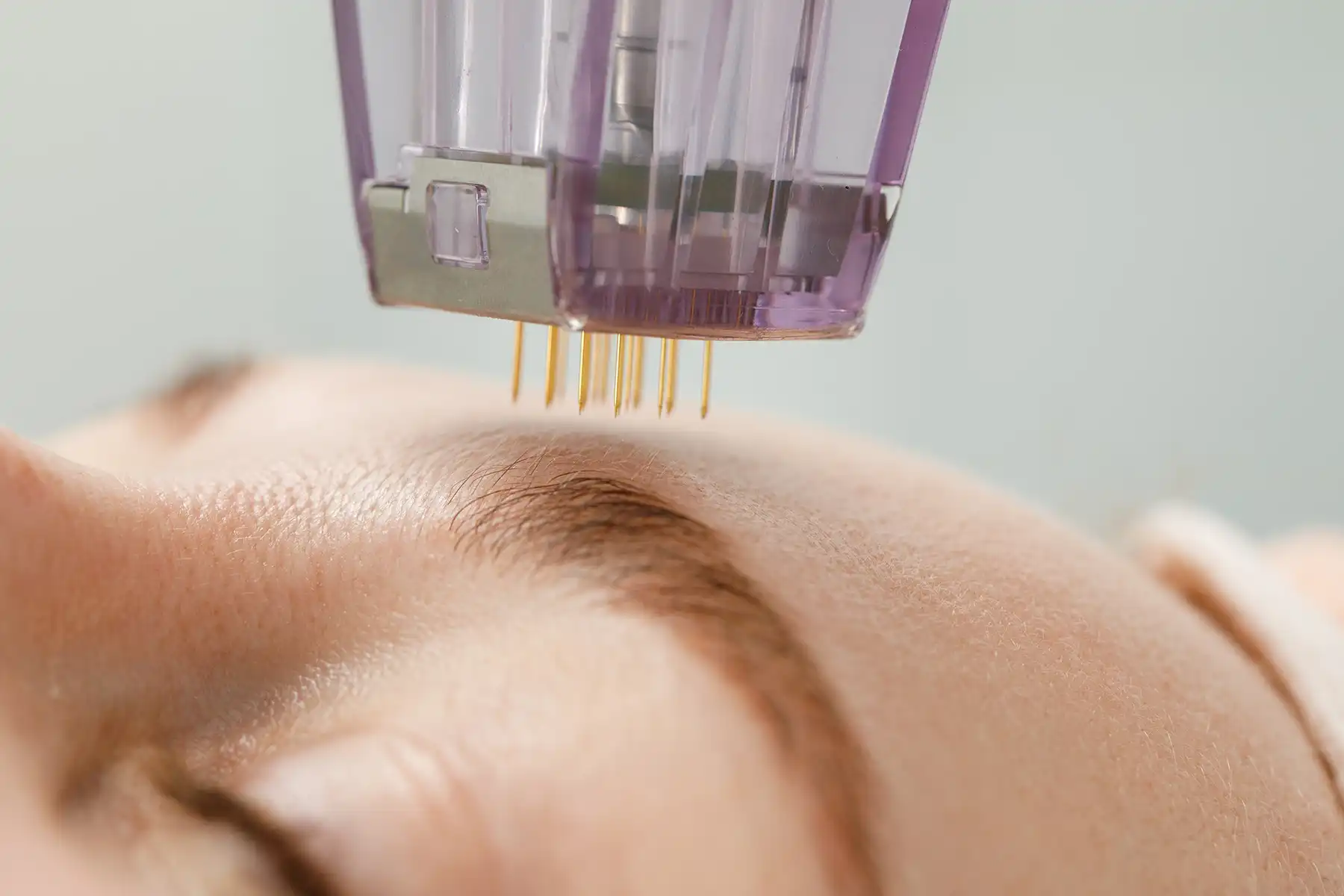 Microneedling device on a woman's forehead.
